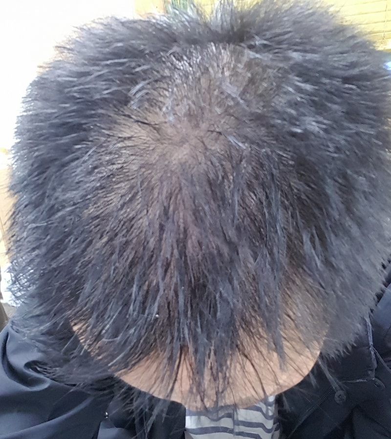 미녹시딜 사용중입니다