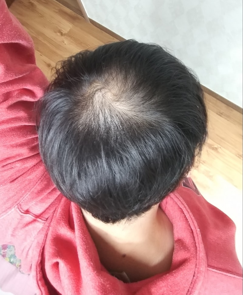 Dutasteride + Minoxidil 5% Starts