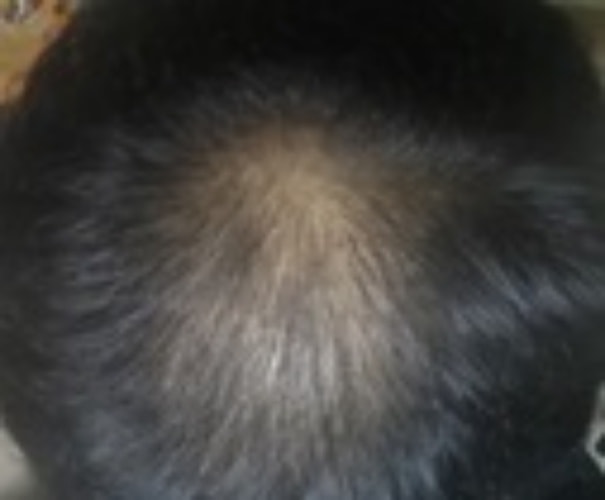 피나+미녹 3개월 후기입니다