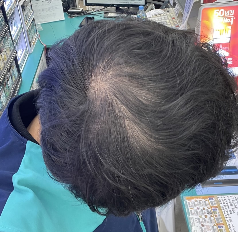 &lt;약 복용 후 4개월 차&gt;