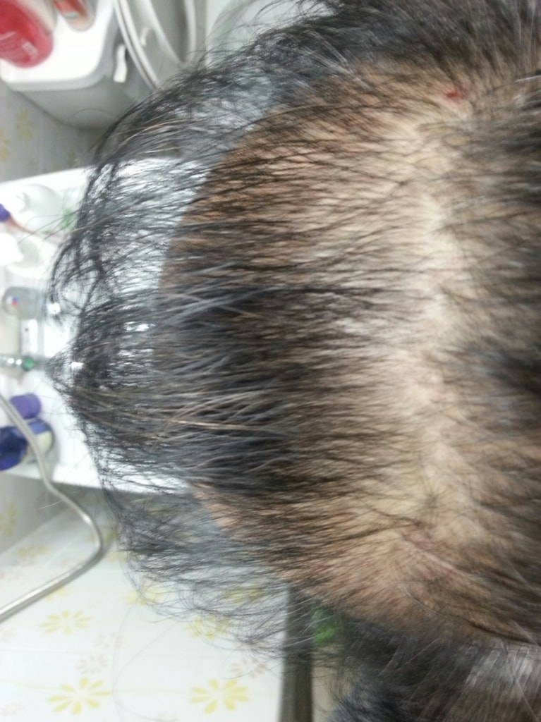 这是服用1个月的Prosca后记。