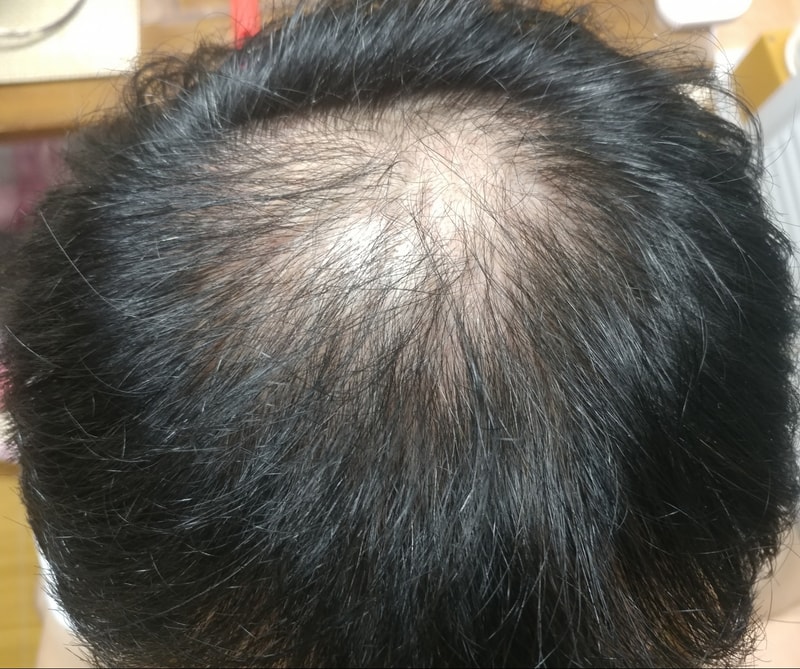 Propecia Copy Drug Review for 4 Months