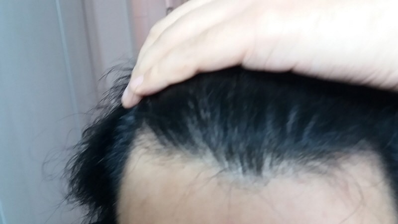 프카 미녹 11개월 차