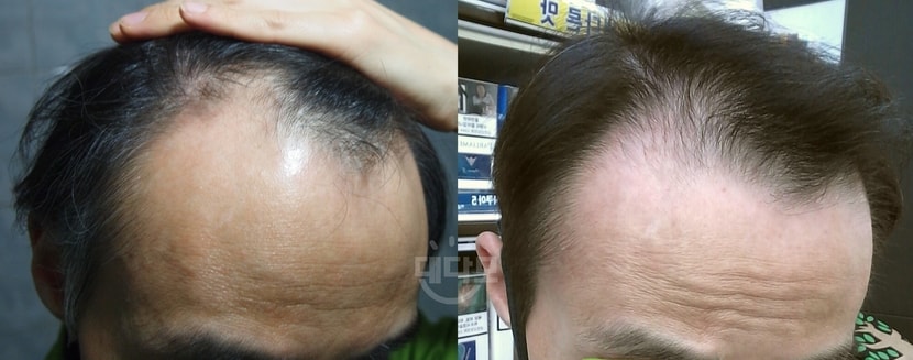 3개월 비교샷