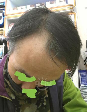 2020년2월 탈모관리 처음시작