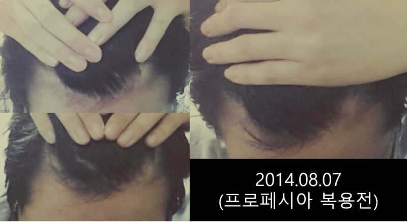 第一次上传这样的。 M字... 这是Propecia服用2年的照片后记。