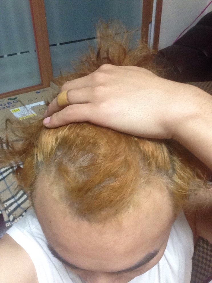 服用阿凡达特1年地照片后记