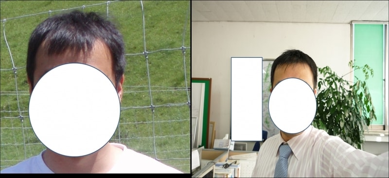 脱发克服器（米诺地尔）。 照片附后)