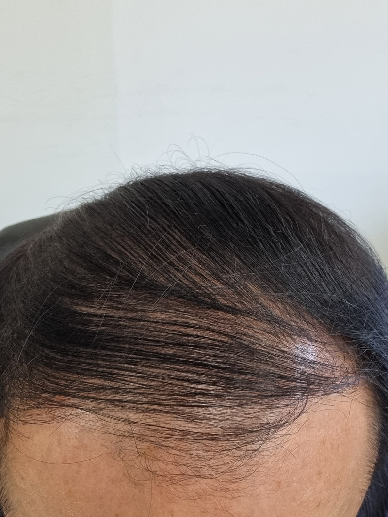 Taking Propecia in Year 2