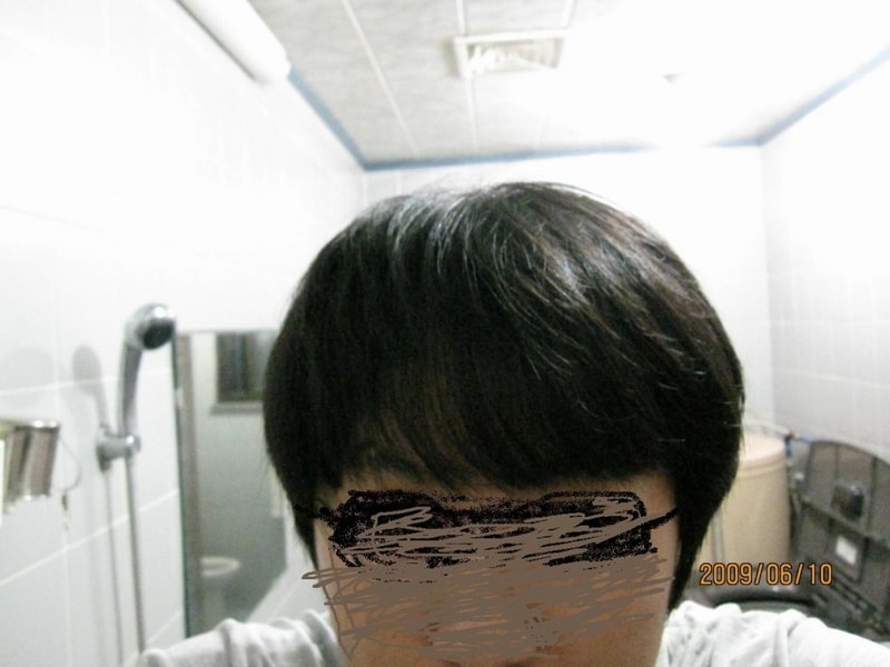 米诺地尔（未产） 10% 5% 使用器