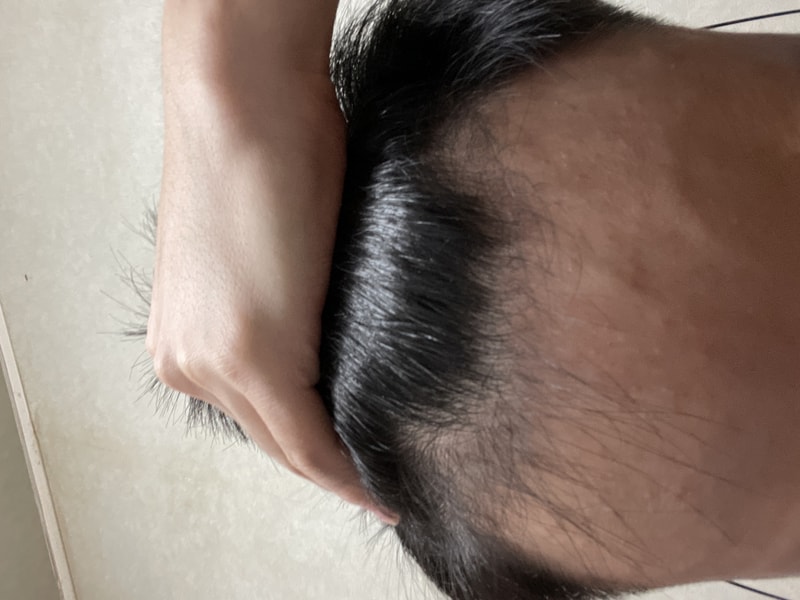 20대 후반 피나스테리드계열 카피약 복용 1달째입니다