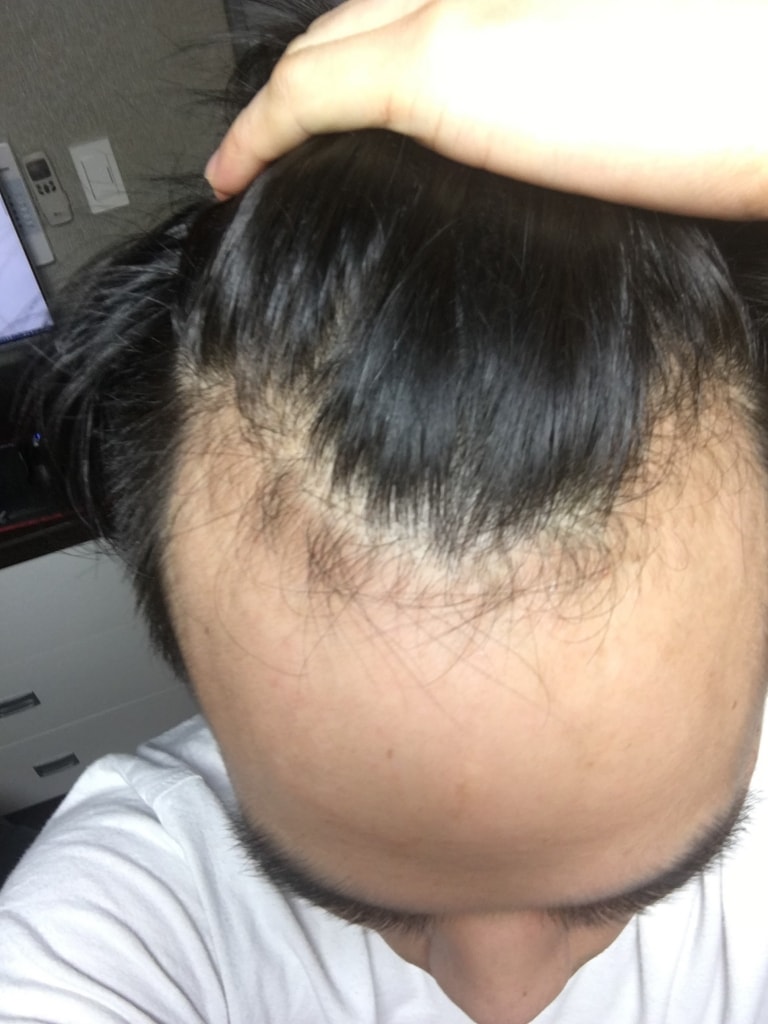 작년 이맘때쯤 미녹시딜 단일사용.. 실패중