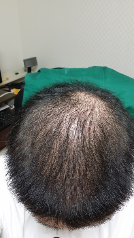 아보다트 + 미녹시딜S 대략 50일차 경과보고 + 물로만씻기 30일차