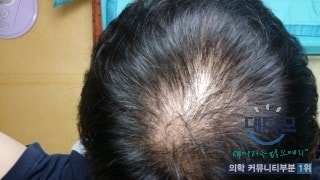 FFF + Myloxil 已进行近两个月（第51天）