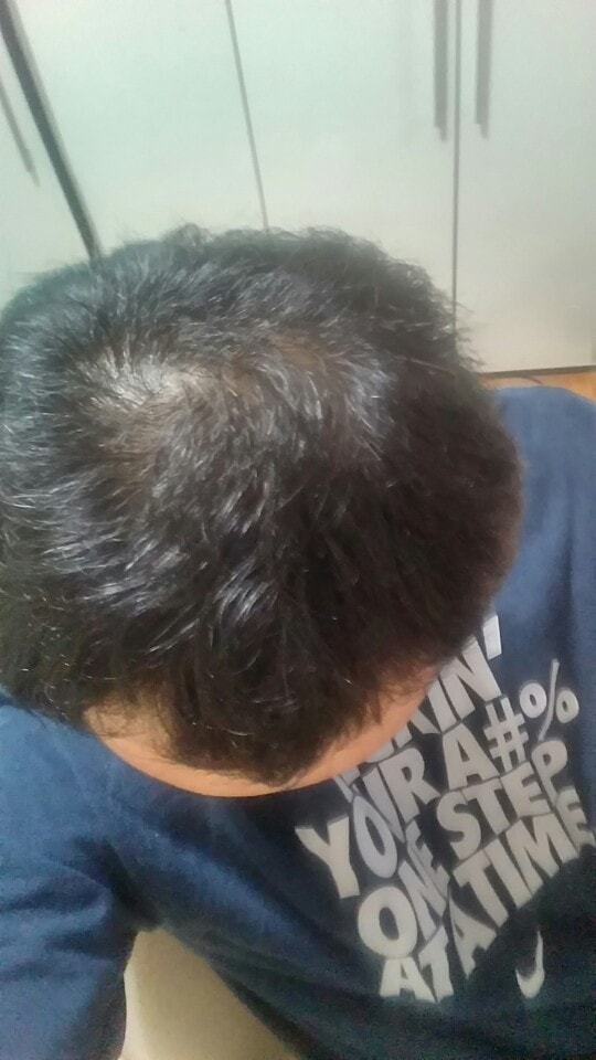 M자 탈모 떄문에 암울합니다 어떡해야 될런지 .... 조언이나 충고좀 부탁드립니다