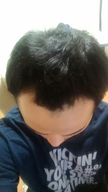 탈모