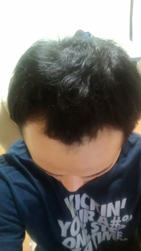 탈모