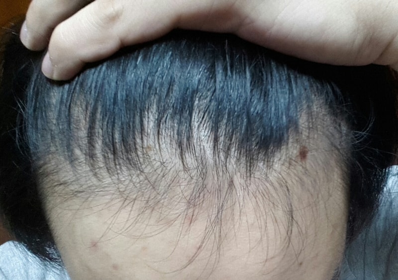 雅培五个月后期