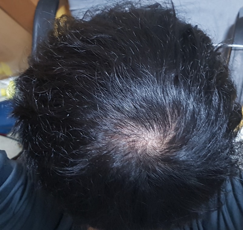 脱发第3周治疗状态后期