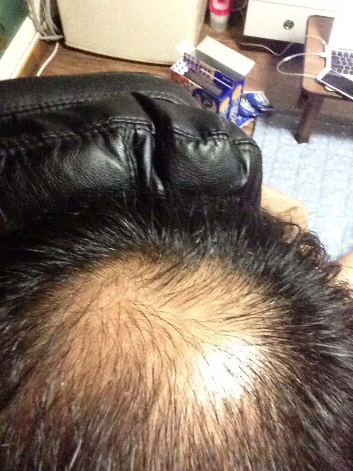 阿伏特20天，米诺地尔+潘西地尔1个月。