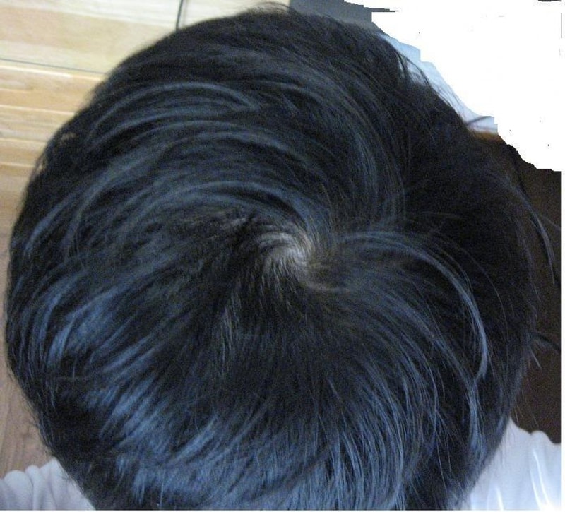 프페3달 15일 꼬박꼬박 먹었습니다 -ㅅ- 믿겨지지가 않네요;