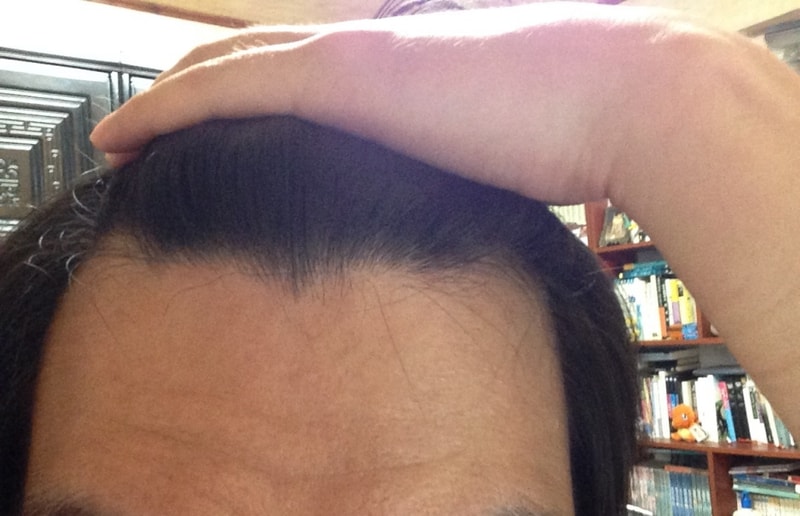 두타 + 미녹 복합처방