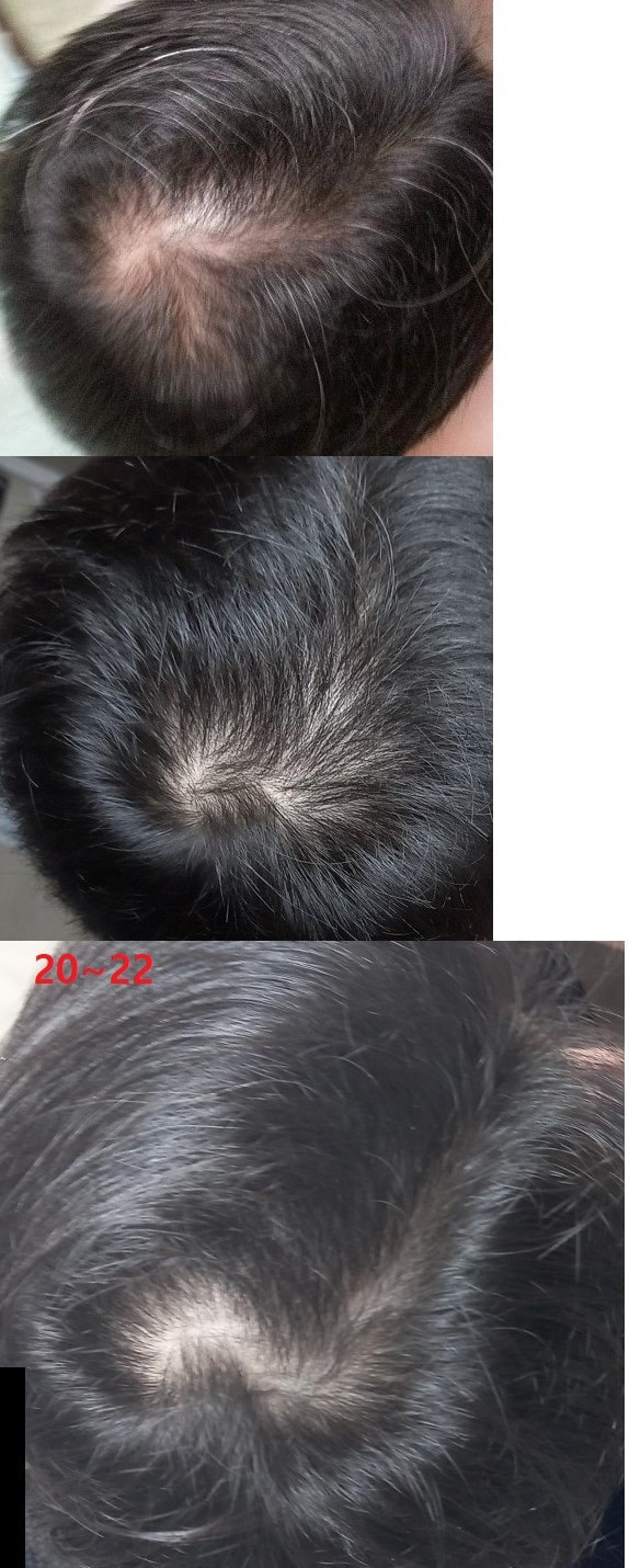 피나 핀스톰정 5년 복용차입니다