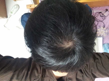 모나드정 5개월, 미녹시딜 1년2개월 사진 한번 올려봅니다.