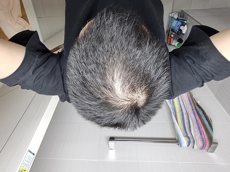 ドゥータ系列薬物 4年+ミノキシジル12週目体験談