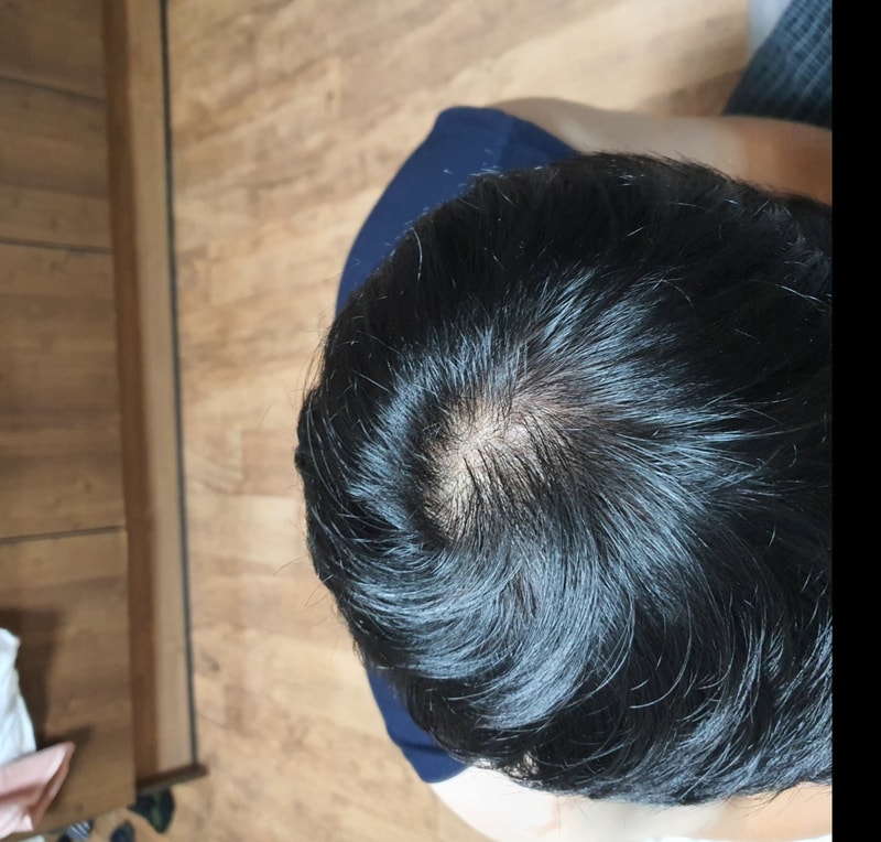<Comparison!!> Propecia 6 months + Minoxidil 3 months