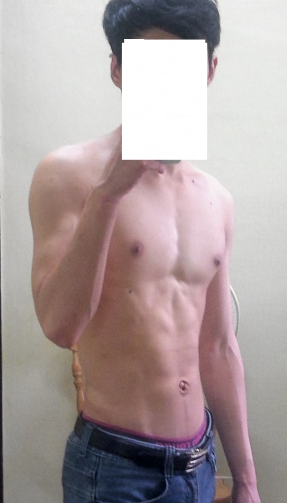 Pinasta (Pka) 12 Months of Type M Hair Loss (Attached Comparative Photo)