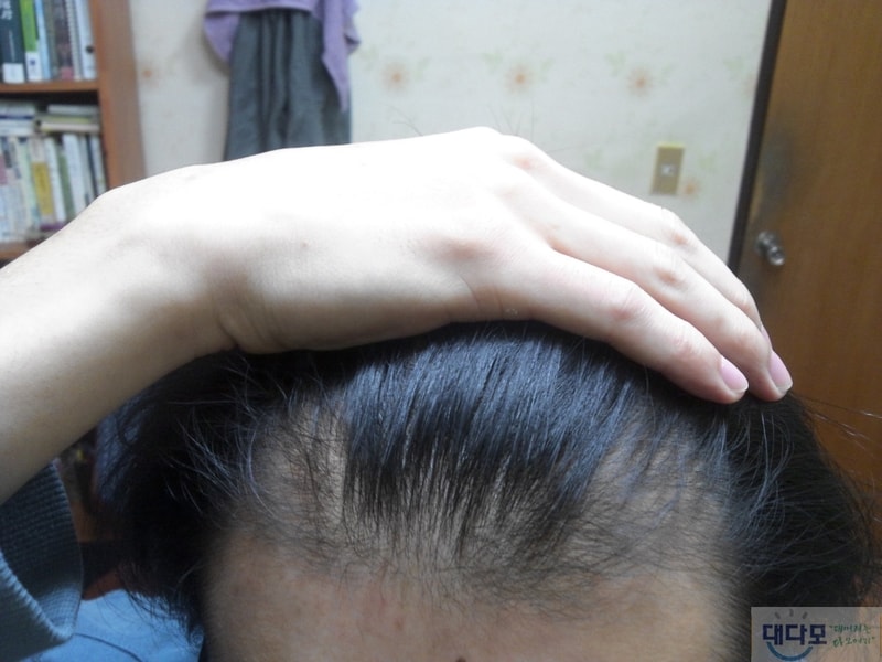 服用Finasta（普卡）10个月，M型脱发（1个月服用比较照片附后）