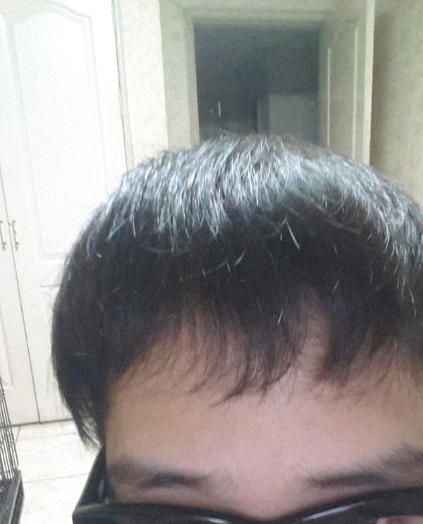 프로스카 1/4, 미녹시딜 하루 1회 1일차 시작합니다.