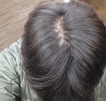 2달후 이때부터 얇은 머리카락이 보이고 부양력이 생김