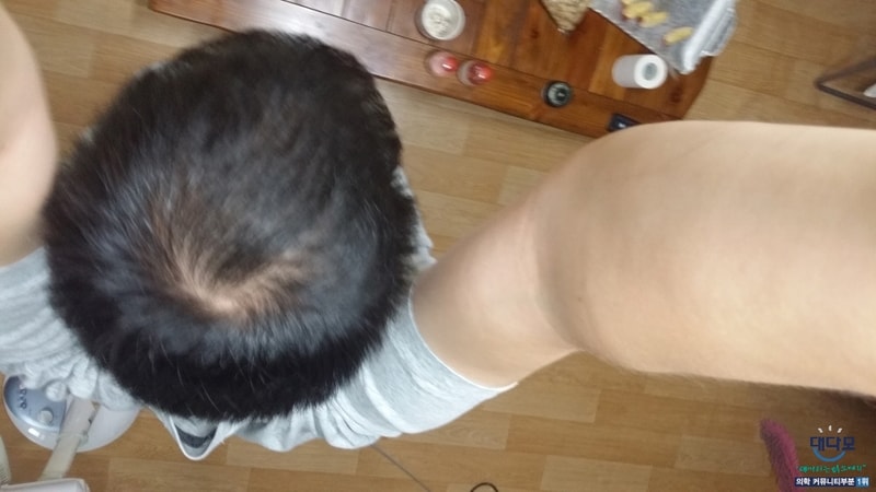 아보다트+미녹시딜 8개월차 후기