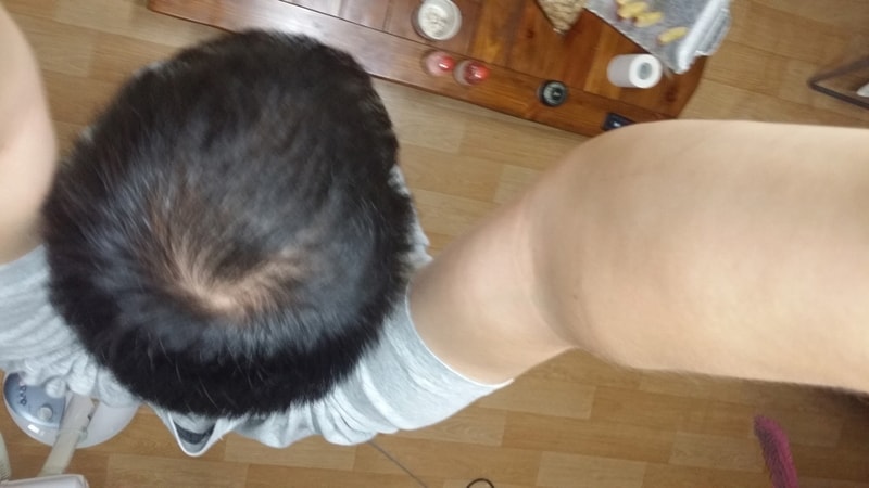 아보다트+미녹시딜 10개월차 후기