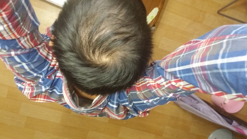 abote+minoxidil 4个月后期