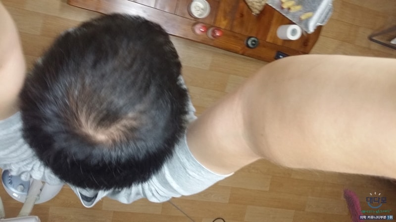 아보다트+미녹 5개월차