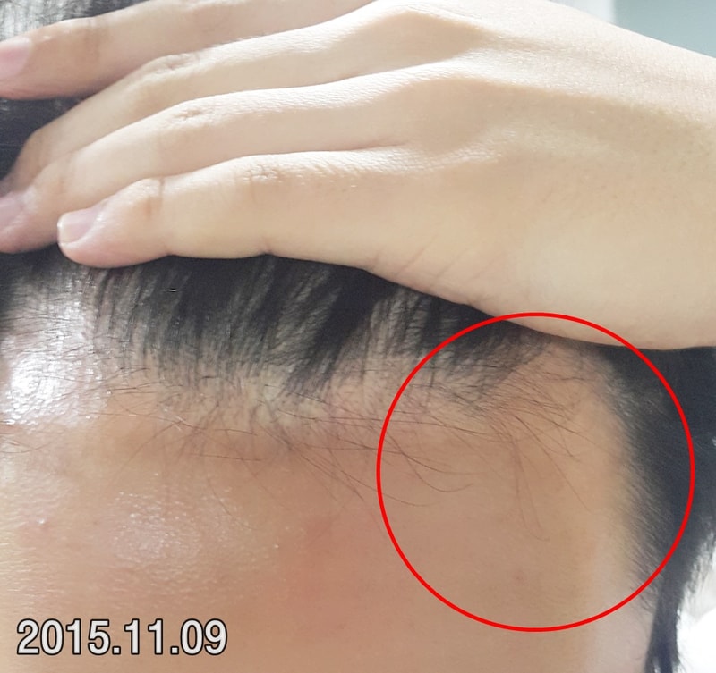 服用脱发医院处方药两个月。