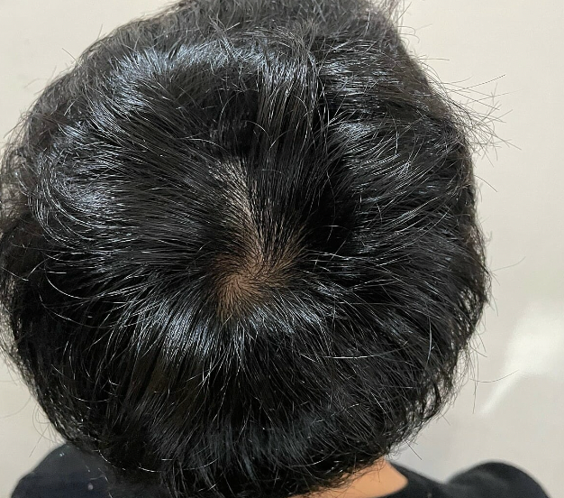 ミノキシジル後記