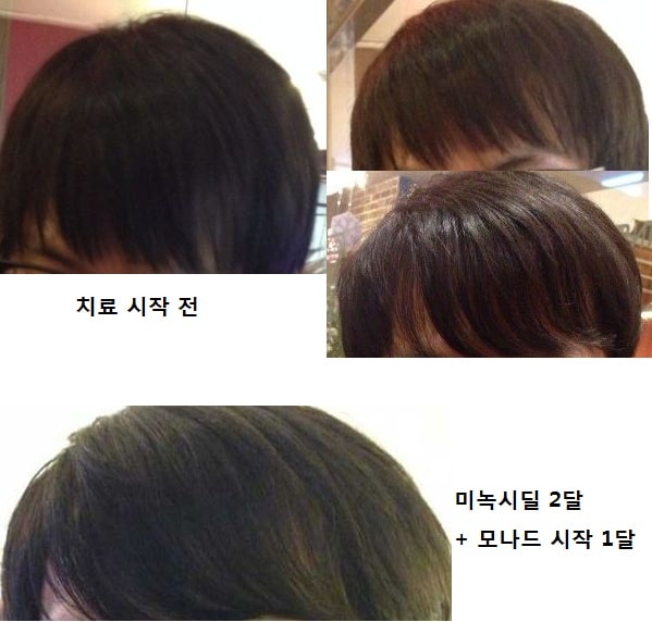 치료 시작전 머리 상태 입니다.