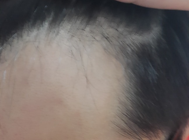 오른쪽 이마라인