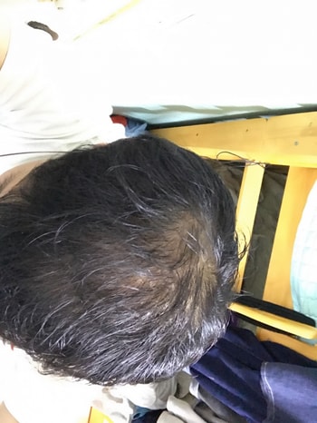 미녹시딜 4개월차