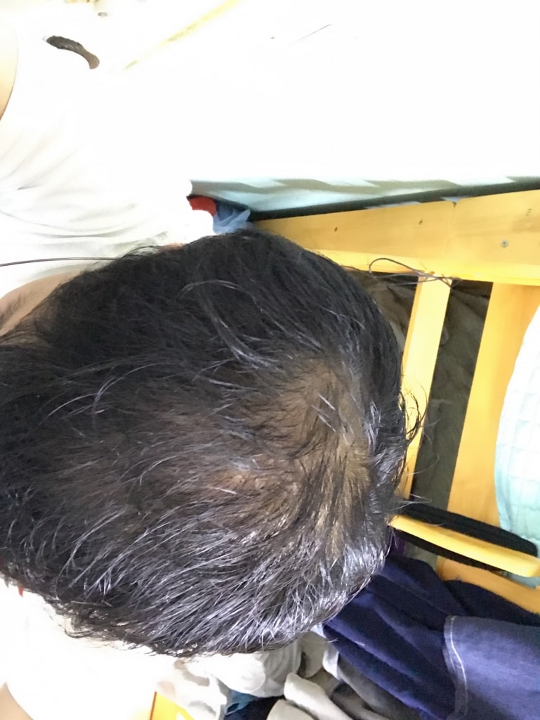 미녹시딜 4개월차