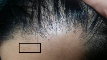 아보 복용 50일차