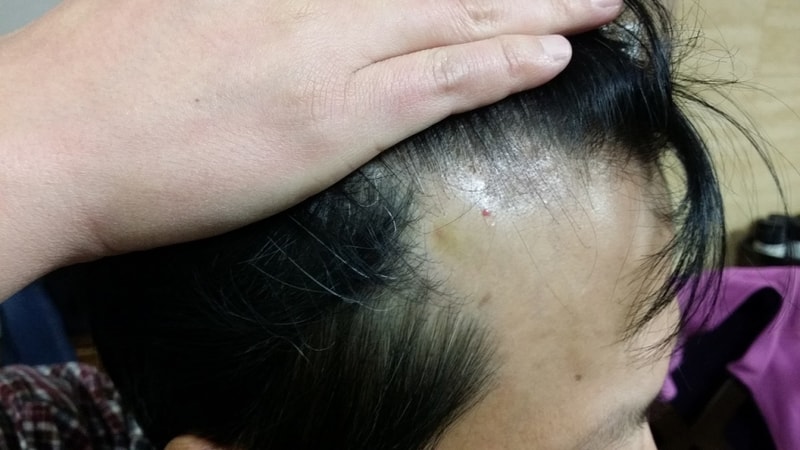 아보다트 복용전, 22일차, 37일차