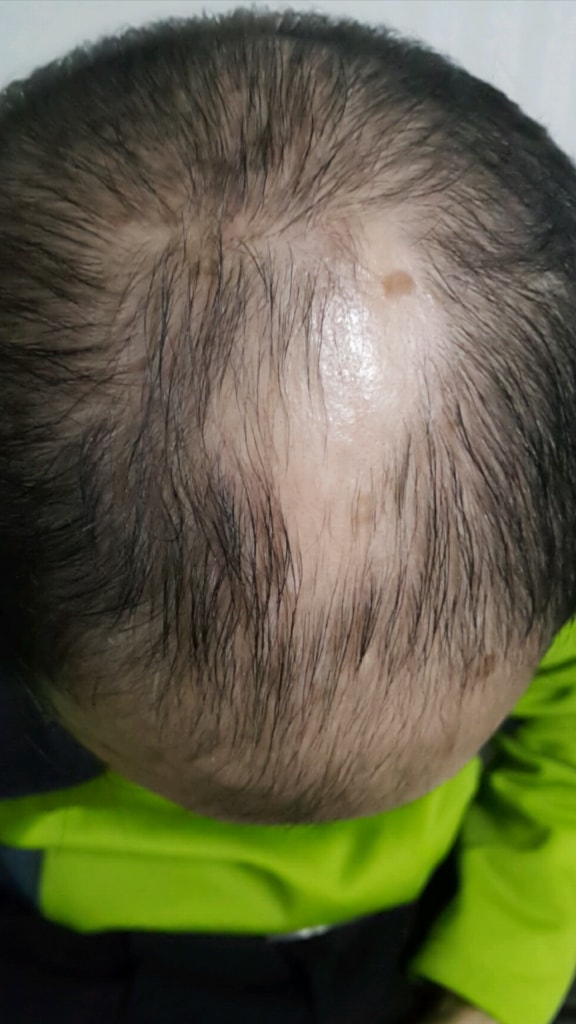 오늘 사진입니다. 미녹시딜액을 바른후 입니다.