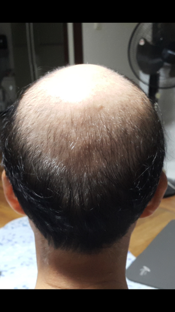 8월20일약복용시작 할때 사진입니다. 
