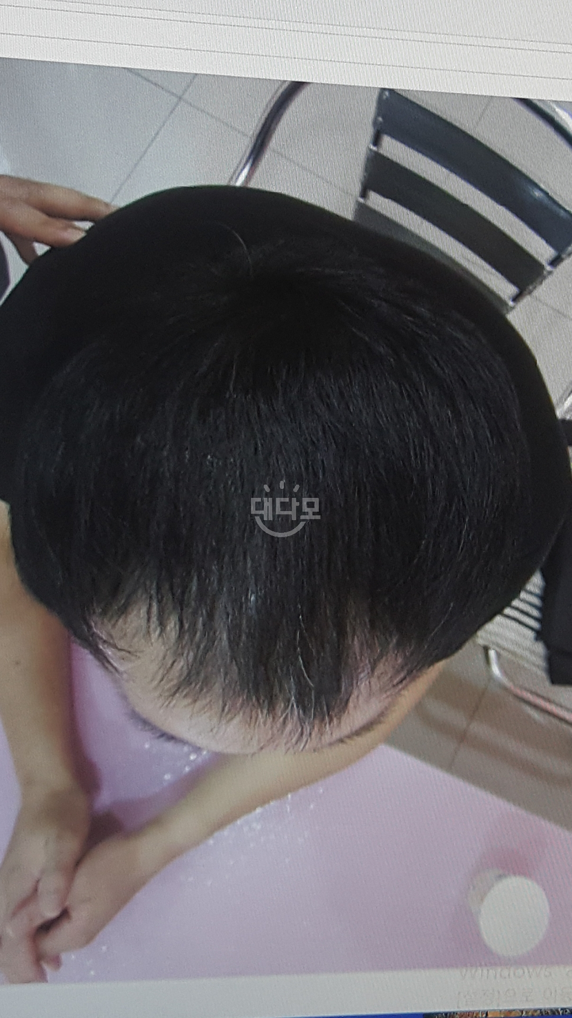 다모다트 6개월후