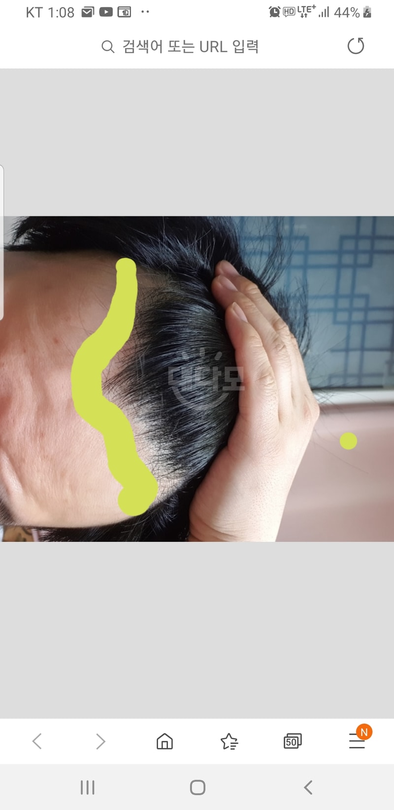 是服用阿凡达6个月的后期。